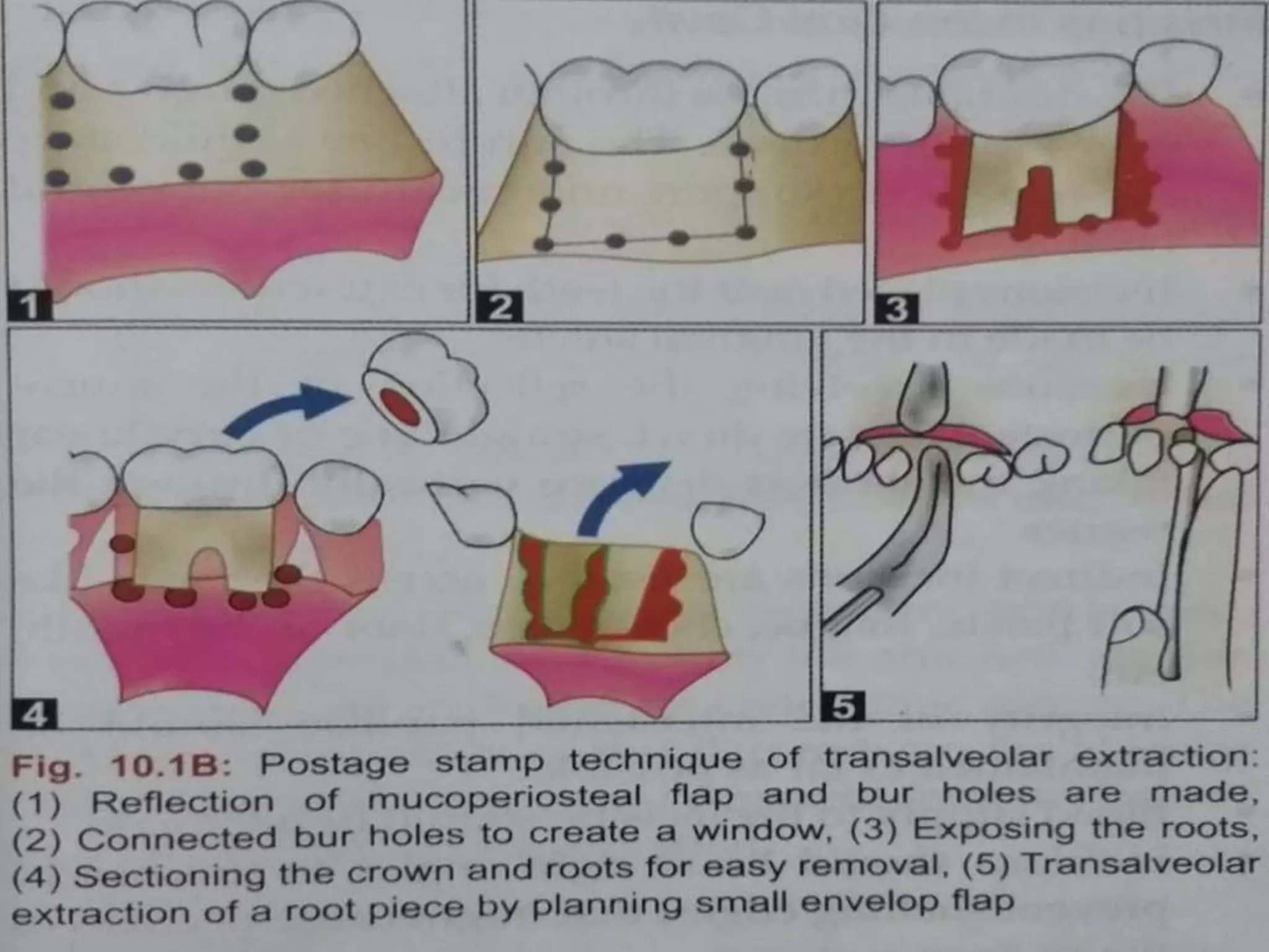 Transalveolar Extraction of tooth | PPTX