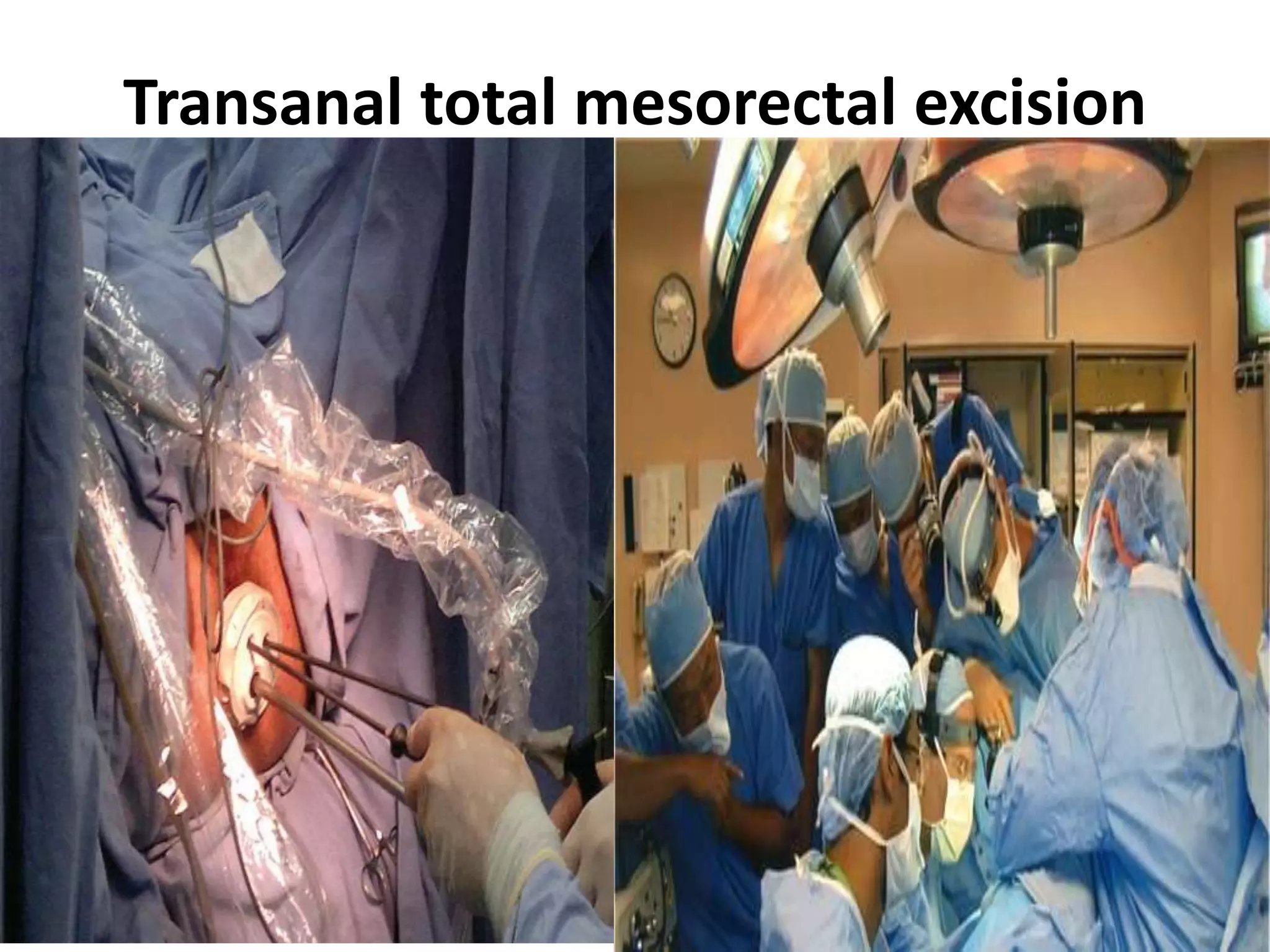 Transanal total mesorectal excision PPT