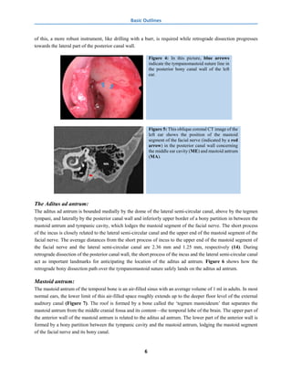 Transcanal Endoscopic Mastoid Approach- A new access for the mastoid ...