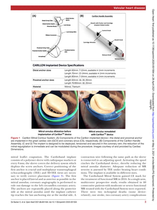3
De Backer O, et al. Open Heart 2021;8:e001564. doi:10.1136/openhrt-2020-001564
Valvular heart disease
mitral leaflet coaptation. The Cardioband implant
consists of a polyester sleeve with radiopaque markers at
every 8 mm; the sleeve covers the delivery system which
deploys the screw anchors. Correct positioning of the
first anchor is crucial and multiplanar transesophageal
echocardiography (TEE) and 3D-­
TEE views are neces-
sary to verify correct placement (figure 3). The first
anchor is placed lateral and as anterior as possible in the
mitral annulus; coronary angiography is performed to
rule out damage to the left circumflex coronary artery.
The anchors are repeatedly placed along the posterior
side at the mitral annulus until the implant catheter
tip reaches the last anchoring site at the medial side. A
contraction wire following the same path as the sleeve
is connected to an adjusting spool. Activating the spool
cinches the Cardioband device, thereby reducing the
mitral annular diameter. Adequate reduction of MR
severity is assessed by TEE under beating heart condi-
tions. The implant is available in different sizes.
The Cardioband Mitral System gained CE mark for
the treatment of functional MR in 2016. In a single-­
arm,
multicentre prospective study, results obtained in 60
consecutive patients with moderate or severe functional
MR treated with the Cardioband System were reported.
There were two in-­
hospital deaths (none device-­
related), one stroke, two coronary artery complications
Figure 1  Carillon Mitral Contour System. (A) Components of the Carillon implanted device—the distal and proximal anchor
are implanted in the great cardiac vein (GCV) and coronary sinus (CS), respectively. (B) Components of the Carillon Handle
Assembly. (C and D) The implant is designed to be deployed, tensioned and secured in the coronary vein; the reduction of the
mitral regurgitation is immediate and can be modulated during the procedure. Images courtesy of and provided by Cardiac
Dimensions. copyright.
on
May
3,
2021
at
India:BMJ-PG
Sponsored.
Protected
by
http://openheart.bmj.com/
Open
Heart:
first
published
as
10.1136/openhrt-2020-001564
on
28
April
2021.
Downloaded
from
 