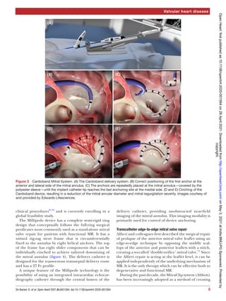 5
De Backer O, et al. Open Heart 2021;8:e001564. doi:10.1136/openhrt-2020-001564
Valvular heart disease
clinical procedures8–10
and is currently enrolling in a
global feasibility study.
The Millipede device has a complete semi-­
rigid ring
design that conceptually follows the full-­
ring surgical
predicates most commonly used as a stand-­
alone mitral
valve repair for patients with functional MR. It has a
nitinol zig-­
zag stent frame that is circumferentially
fixed to the annulus by eight helical anchors. The top
of the frame has eight slider components that can be
individually cinched to achieve tailored downsizing of
the mitral annulus (figure 4). The delivery catheter is
designed for the transvenous transseptal delivery route
and has a 27 Fr profile.
A unique feature of the Millipede technology is the
possibility of using an integrated intracardiac echocar-
diography catheter through the central lumen of the
delivery catheter, providing unobstructed near-­
field
imaging of the mitral annulus. This imaging modality is
primarily used for control of device anchoring.
Transcatheter edge-to-edge mitral valve repair
Alfieri and colleagues first described the surgical repair
of prolapse of the anterior mitral valve leaflet using an
edge-­
to-­
edge technique by opposing the middle scal-
lops of the anterior and posterior leaflets with a stitch,
creating a so-­
called ‘double-­
orifice’ mitral valve.11
Since
the Alfieri repair is acting at the leaflet level, it can be
applied independently of the underlying mechanism of
MR. It is the only therapy which can be effective both to
degenerative and functional MR.
During the past decade, the MitraClip system (Abbott)
has been increasingly adopted as a method of creating
Figure 3  Cardioband Mitral System. (A) The Cardioband delivery system. (B) Correct positioning of the first anchor at the
anterior and lateral side of the mitral annulus. (C) The anchors are repeatedly placed at the mitral annulus—covered by the
polyester sleeve—until the implant catheter tip reaches the last anchoring site at the medial side. (D and E) Cinching of the
Cardioband device, resulting in a reduction of the mitral annular diameter and mitral regurgitation severity. Images courtesy of
and provided by Edwards Lifesciences.
copyright.
on
May
3,
2021
at
India:BMJ-PG
Sponsored.
Protected
by
http://openheart.bmj.com/
Open
Heart:
first
published
as
10.1136/openhrt-2020-001564
on
28
April
2021.
Downloaded
from
 