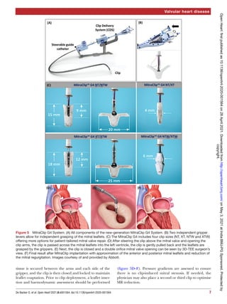 7
De Backer O, et al. Open Heart 2021;8:e001564. doi:10.1136/openhrt-2020-001564
Valvular heart disease
tissue is secured between the arms and each side of the
gripper, and the clip is then closed and locked to maintain
leaflet coaptation. Prior to clip deployment, a leaflet inser-
tion and haemodynamic assessment should be performed
(figure 5D–F). Pressure gradients are assessed to ensure
there is no clip-­
induced mitral stenosis. If needed, the
physician may also place a second or third clip to optimise
MR reduction.
Figure 5  MitraClip G4 System. (A) All components of the new-­
generation MitraClip G4 System. (B) Two independent gripper
levers allow for independent grasping of the mitral leaflets. (C) The MitraClip G4 includes four clip sizes (NT, XT, NTW and XTW)
offering more options for patient-­
tailored mitral valve repair. (D) After steering the clip above the mitral valve and opening the
clip arms, the clip is passed across the mitral leaflets into the left ventricle, the clip is gently pulled back and the leaflets are
grasped by the grippers. (E) Next, the clip is closed and a double orifice mitral valve opening can be seen by 3D-­
TEE surgeon’s
view. (F) Final result after MitraClip implantation with approximation of the anterior and posterior mitral leaflets and reduction of
the mitral regurgitation. Images courtesy of and provided by Abbott.
copyright.
on
May
3,
2021
at
India:BMJ-PG
Sponsored.
Protected
by
http://openheart.bmj.com/
Open
Heart:
first
published
as
10.1136/openhrt-2020-001564
on
28
April
2021.
Downloaded
from
 
