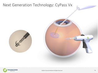 10©2014 Transcend Medical All Rights Reserved
Next Generation Technology: CyPass Vx
 