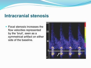 Intracranial stenosis
 Focal stenosis increases the
flow velocities represented
by the ‘bruit’, seen as a
symmetrical artifact on either
side of the baseline.
 