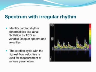 Spectrum with irregular rhythm
 Identify cardiac rhythm
abnormalities like atrial
fibrillation by TCD as
variable Doppler spectra and
velocities.
 The cardiac cycle with the
highest flow velocities is
used for measurement of
various parameters.
 