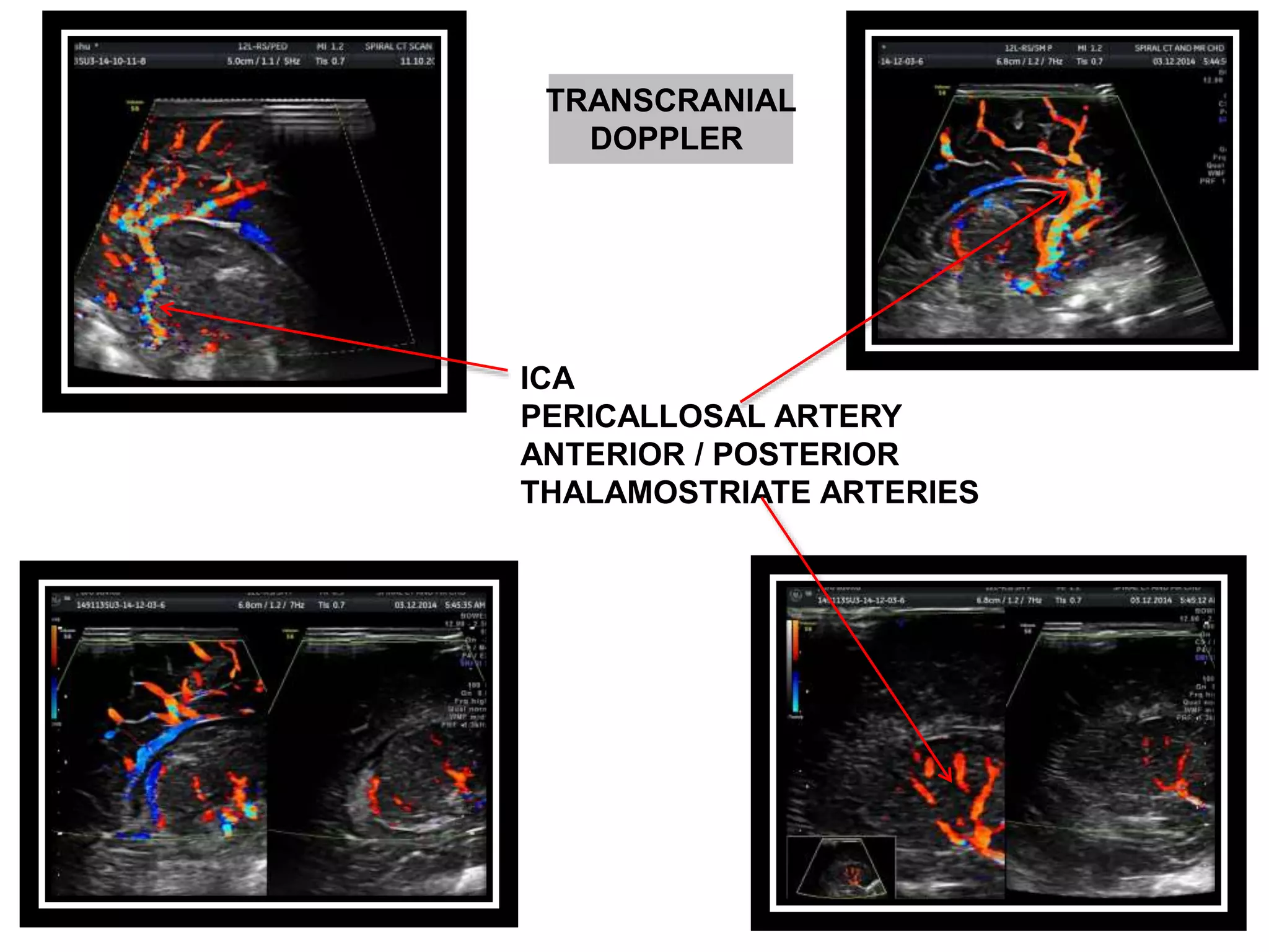 Transcranial doppler advanced usg lounge | PPTX