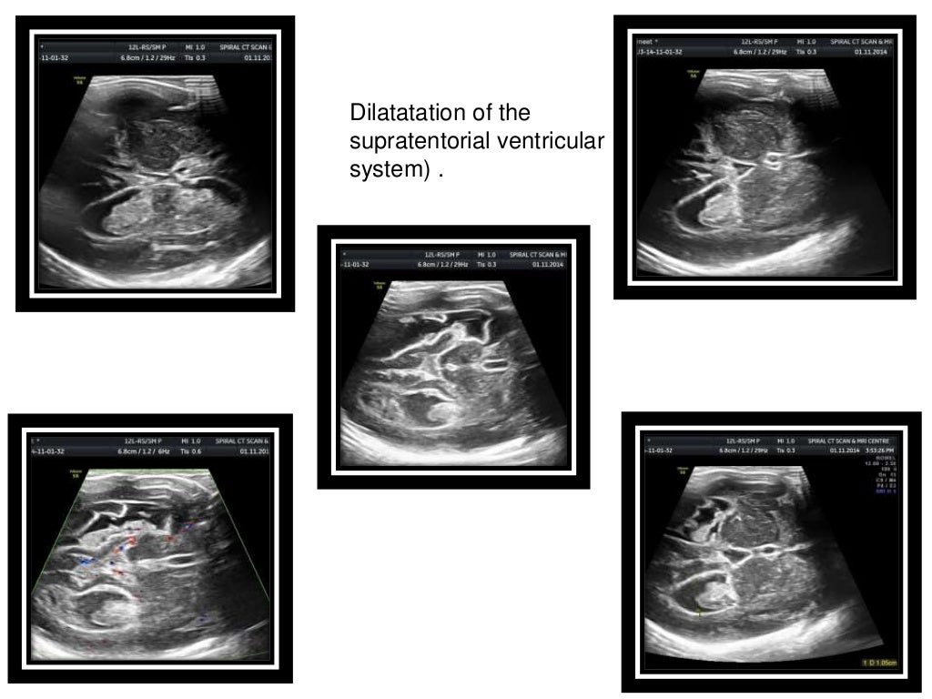 transcranial doppler guidelines transcranial doppler guidelines
