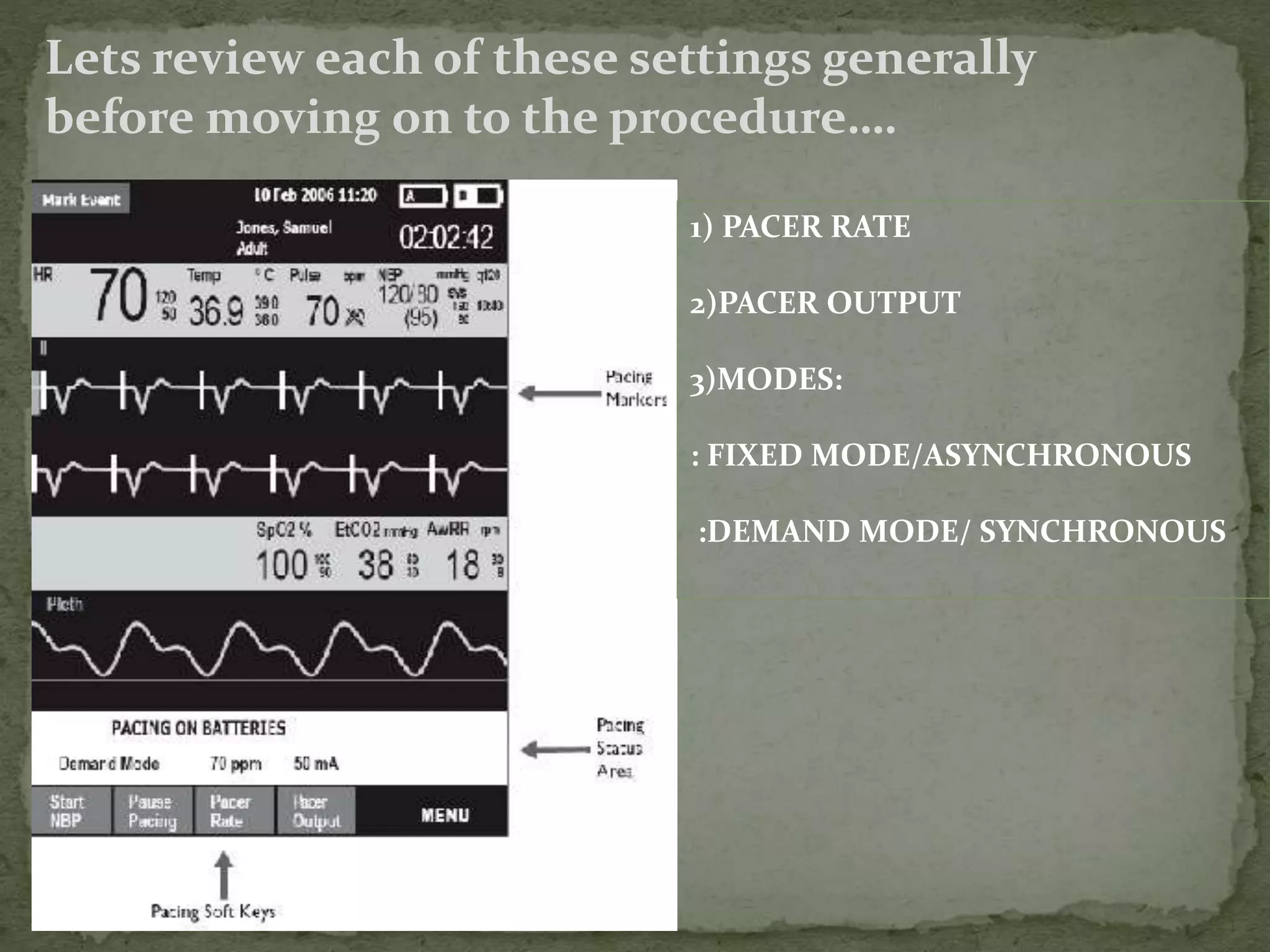Unlocking The Mystery: Optimal Initial Impulse Settings For Transcutaneous Pacing - 1v30oek