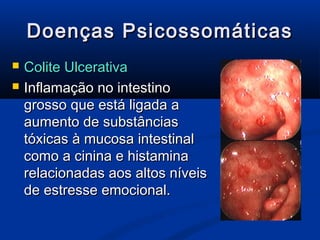 Doenças Psicossomáticas
   Colite Ulcerativa
   Inflamação no intestino
    grosso que está ligada a
    aumento de substâncias
    tóxicas à mucosa intestinal
    como a cinina e histamina
    relacionadas aos altos níveis
    de estresse emocional.
 