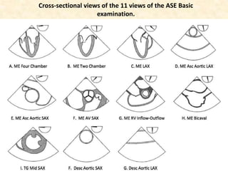 Transesophageal echocardiography | PPSX