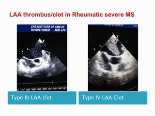 Type Ib LAA clot Type IV LAA Clot
 