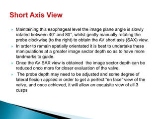  Maintaining this esophageal level the image plane angle is slowly
rotated between 40° and 80°, whilst gently manually rotating the
probe clockwise (to the right) to obtain the AV short axis (SAX) view.
 In order to remain spatially orientated it is best to undertake these
manipulations at a greater image sector depth so as to have more
landmarks to guide.
 Once the AV SAX view is obtained the image sector depth can be
reduced once more for closer evaluation of the valve.
 The probe depth may need to be adjusted and some degree of
lateral flexion applied in order to get a perfect “en face” view of the
valve, and once achieved, it will allow an exquisite view of all 3
cusps
 