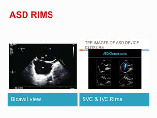 Bicaval view SVC & IVC Rims
 