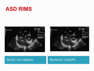 Aortic rim (down) Posterior rim(UP)
 