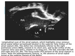 Longitudinal scan of the atrial septum, which highlights sinus venosus
atrial septal defect (arrowhead) located in the superior fatty limbus of the
atrial septum (AS). The defect lies immediately inferior to the right
pulmonary artery (RPA), viewed in its short axis, and to the orifice of the
superior vena cava (SVC), viewed in its long axis. The SVC overrides the left
and right atria (LA, RA). The fossa ovalis (FO) portion of the atrial septum is
intact. Note the pathognomonic feature, ie, the absence of atrial septal
 
