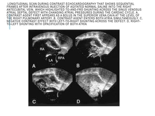 LONGITUDINAL SCAN DURING CONTRAST ECHOCARDIOGRAPHY THAT SHOWS SEQUENTIAL
FRAMES AFTER INTRAVENOUS INJECTION OF AGITATED NORMAL SALINE INTO THE RIGHT
ANTECUBITAL VEIN, WHICH HIGHLIGHTED TO-AND-FRO SHUNTING ACROSS THE SINUS VENOSUS
ATRIAL SEPTAL DEFECT WITH CHANGING ATRIAL PRESSURES DURING THE CARDIAC CYCLE. A,
CONTRAST AGENT FIRST APPEARS AS A BOLUS IN THE SUPERIOR VENA CAVA AT THE LEVEL OF
THE RIGHT PULMONARY ARTERY. B, CONTRAST AGENT ENTERS BOTH ATRIA SIMULTANEOUSLY. C,
NEGATIVE CONTRAST EFFECT WITH LEFT-TO-RIGHT SHUNTING ACROSS THE DEFECT. D, RIGHT-
TO-LEFT SHUNTING WITH OPACIFICATION OF BOTH ATRIA
 