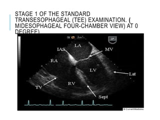 STAGE 1 OF THE STANDARD
TRANSESOPHAGEAL (TEE) EXAMINATION. (
MIDESOPHAGEAL FOUR-CHAMBER VIEW) AT 0
DEGREE).
 