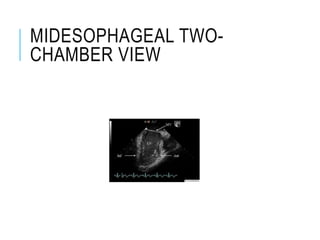 MIDESOPHAGEAL TWO-
CHAMBER VIEW
 