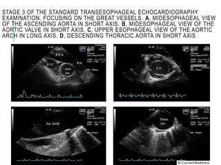 STAGE 3 OF THE STANDARD TRANSESOPHAGEAL ECHOCARDIOGRAPHY
EXAMINATION, FOCUSING ON THE GREAT VESSELS. A, MIDESOPHAGEAL VIEW
OF THE ASCENDING AORTA IN SHORT AXIS. B, MIDESOPHAGEAL VIEW OF THE
AORTIC VALVE IN SHORT AXIS. C, UPPER ESOPHAGEAL VIEW OF THE AORTIC
ARCH IN LONG AXIS. D, DESCENDING THORACIC AORTA IN SHORT AXIS
 