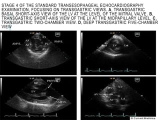 STAGE 4 OF THE STANDARD TRANSESOPHAGEAL ECHOCARDIOGRAPHY
EXAMINATION, FOCUSING ON TRANSGASTRIC VIEWS. A, TRANSGASTRIC
BASAL SHORT-AXIS VIEW OF THE LV AT THE LEVEL OF THE MITRAL VALVE. B,
TRANSGASTRIC SHORT-AXIS VIEW OF THE LV AT THE MIDPAPILLARY LEVEL. C,
TRANSGASTRIC TWO-CHAMBER VIEW. D, DEEP TRANSGASTRIC FIVE-CHAMBER
VIEW
 