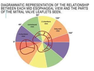 DIAGRAMMATIC REPRESENTATION OF THE RELATIONSHIP
BETWEEN EACH MID ESOPHAGEAL VIEW AND THE PARTS
OF THE MITRAL VALVE LEAFLETS SEEN.
 