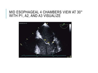 MID ESOPHAGEAL 4 CHAMBERS VIEW AT 30°
WITH P1, A2, AND A3 VISUALIZE
 