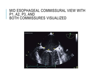 MID ESOPHAGEAL COMMISSURAL VIEW WITH
P1, A2, P3, AND
BOTH COMMISSURES VISUALIZED
 