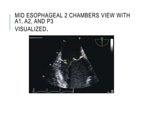 MID ESOPHAGEAL 2 CHAMBERS VIEW WITH
A1, A2, AND P3
VISUALIZED.
 