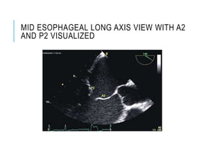 MID ESOPHAGEAL LONG AXIS VIEW WITH A2
AND P2 VISUALIZED
 