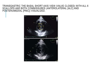 TRANSGASTRIC THE BASAL SHORT AXIS VIEW (VALVE CLOSED) WITH ALL 6
SCALLOPS AND BOTH COMMISSURES (ANTEROLATERAL [ALC] AND
POSTEROMEDIAL [PMC]) VISUALIZED.
 