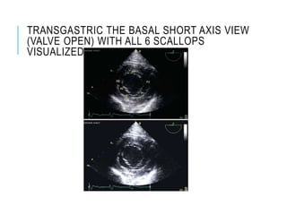 TRANSGASTRIC THE BASAL SHORT AXIS VIEW
(VALVE OPEN) WITH ALL 6 SCALLOPS
VISUALIZED
 