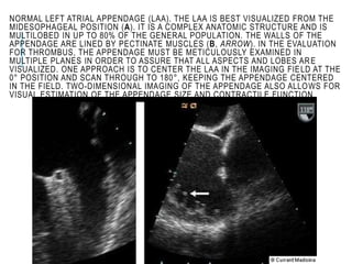 NORMAL LEFT ATRIAL APPENDAGE (LAA). THE LAA IS BEST VISUALIZED FROM THE
MIDESOPHAGEAL POSITION (A). IT IS A COMPLEX ANATOMIC STRUCTURE AND IS
MULTILOBED IN UP TO 80% OF THE GENERAL POPULATION. THE WALLS OF THE
APPENDAGE ARE LINED BY PECTINATE MUSCLES (B, ARROW). IN THE EVALUATION
FOR THROMBUS, THE APPENDAGE MUST BE METICULOUSLY EXAMINED IN
MULTIPLE PLANES IN ORDER TO ASSURE THAT ALL ASPECTS AND LOBES ARE
VISUALIZED. ONE APPROACH IS TO CENTER THE LAA IN THE IMAGING FIELD AT THE
0° POSITION AND SCAN THROUGH TO 180°, KEEPING THE APPENDAGE CENTERED
IN THE FIELD. TWO-DIMENSIONAL IMAGING OF THE APPENDAGE ALSO ALLOWS FOR
VISUAL ESTIMATION OF THE APPENDAGE SIZE AND CONTRACTILE FUNCTION
 
