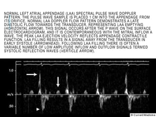 NORMAL LEFT ATRIAL APPENDAGE (LAA) SPECTRAL PULSE WAVE DOPPLER
PATTERN. THE PULSE WAVE SAMPLE IS PLACED 1 CM INTO THE APPENDAGE FROM
ITS ORIFICE. NORMAL LAA DOPPLER FLOW PATTERN DEMONSTRATES A LATE
DIASTOLIC FLOW TOWARDS THE TRANSDUCER, REPRESENTING LAA EMPTYING
(HORIZONTAL ARROW). THIS SIGNAL OCCURS AFTER THE P WAVE ON THE SURFACE
ELECTROCARDIOGRAM, AND IT IS CONTEMPORANEOUS WITH THE MITRAL INFLOW A
WAVE. THE PEAK LAA EJECTION VELOCITY REFLECTS APPENDAGE CONTRACTILE
FUNCTION. LAA FILLING RESULTS IN A SIGNAL AWAY FROM THE TRANSDUCER IN
EARLY SYSTOLE (ARROWHEAD). FOLLOWING LAA FILLING THERE IS OFTEN A
VARIABLE NUMBER OF LOW AMPLITUDE INFLOW AND OUTFLOW SIGNALS TERMED
SYSTOLIC REFLECTION WAVES (VERTICLE ARROW).
 
