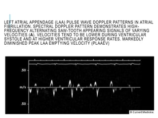 LEFT ATRIAL APPENDAGE (LAA) PULSE WAVE DOPPLER PATTERNS IN ATRIAL
FIBRILLATION. SPECTRAL DOPPLER PATTERN DEMONSTRATES HIGH-
FREQUENCY ALTERNATING SAW-TOOTH APPEARING SIGNALS OF VARYING
VELOCITIES (A). VELOCITIES TEND TO BE LOWER DURING VENTRICULAR
SYSTOLE AND AT HIGHER VENTRICULAR RESPONSE RATES. MARKEDLY
DIMINISHED PEAK LAA EMPTYING VELOCITY (PLAAEV)
 