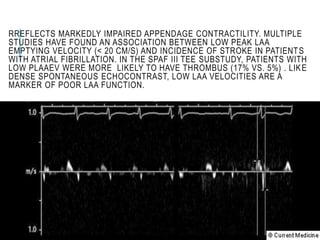 RREFLECTS MARKEDLY IMPAIRED APPENDAGE CONTRACTILITY. MULTIPLE
STUDIES HAVE FOUND AN ASSOCIATION BETWEEN LOW PEAK LAA
EMPTYING VELOCITY (< 20 CM/S) AND INCIDENCE OF STROKE IN PATIENTS
WITH ATRIAL FIBRILLATION. IN THE SPAF III TEE SUBSTUDY, PATIENTS WITH
LOW PLAAEV WERE MORE LIKELY TO HAVE THROMBUS (17% VS. 5%) . LIKE
DENSE SPONTANEOUS ECHOCONTRAST, LOW LAA VELOCITIES ARE A
MARKER OF POOR LAA FUNCTION.
 