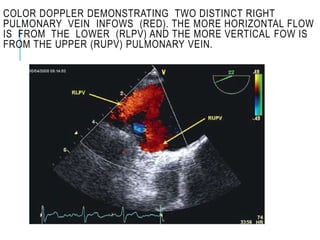 COLOR DOPPLER DEMONSTRATING TWO DISTINCT RIGHT
PULMONARY VEIN INFOWS (RED). THE MORE HORIZONTAL FLOW
IS FROM THE LOWER (RLPV) AND THE MORE VERTICAL FOW IS
FROM THE UPPER (RUPV) PULMONARY VEIN.
 