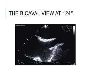 THE BICAVAL VIEW AT 124°.
 