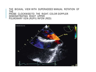 THE BICAVAL VIEW WITH SUPERADDED MANUAL ROTATION OF
THE
PROBE CLOCKWISE/TO THE RIGHT. COLOR DOPPLER
DEMONSTRATING RIGHT UPPER
PULMONARY VEIN (RUPV) INFOW (RED)
 