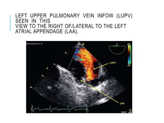 LEFT UPPER PULMONARY VEIN INFOW (LUPV)
SEEN IN THIS
VIEW TO THE RIGHT OF/LATERAL TO THE LEFT
ATRIAL APPENDAGE (LAA).
 