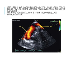 LEFT UPPER AND LOWER PULMONARY VEIN INFOW (RED CODED
BLOOD FOW). THE MORE VERTICAL FOW COMES FROM THE UPPER
(LUPV) AND
THE MORE HORIZONTAL FOW IS FROM THE LOWER (LLPV)
PULMONARY VEIN.
 
