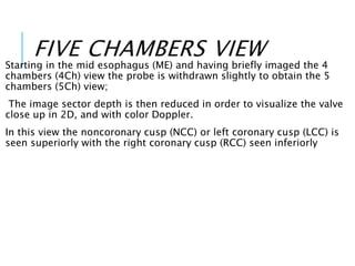 FIVE CHAMBERS VIEW
Starting in the mid esophagus (ME) and having briefly imaged the 4
chambers (4Ch) view the probe is withdrawn slightly to obtain the 5
chambers (5Ch) view;
The image sector depth is then reduced in order to visualize the valve
close up in 2D, and with color Doppler.
In this view the noncoronary cusp (NCC) or left coronary cusp (LCC) is
seen superiorly with the right coronary cusp (RCC) seen inferiorly
 