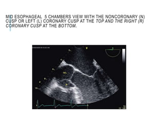 MID ESOPHAGEAL 5 CHAMBERS VIEW WITH THE NONCORONARY (N)
CUSP OR LEFT (L) CORONARY CUSP AT THE TOP AND THE RIGHT (R)
CORONARY CUSP AT THE BOTTOM.
 