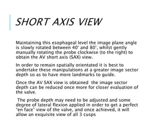 SHORT AXIS VIEW
Maintaining this esophageal level the image plane angle
is slowly rotated between 40° and 80°, whilst gently
manually rotating the probe clockwise (to the right) to
obtain the AV short axis (SAX) view.
In order to remain spatially orientated it is best to
undertake these manipulations at a greater image sector
depth so as to have more landmarks to guide.
Once the AV SAX view is obtained the image sector
depth can be reduced once more for closer evaluation of
the valve.
The probe depth may need to be adjusted and some
degree of lateral flexion applied in order to get a perfect
“en face” view of the valve, and once achieved, it will
allow an exquisite view of all 3 cusps
 