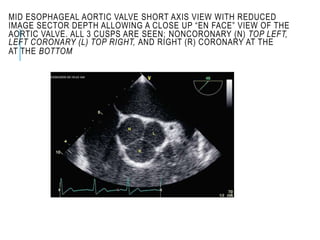 MID ESOPHAGEAL AORTIC VALVE SHORT AXIS VIEW WITH REDUCED
IMAGE SECTOR DEPTH ALLOWING A CLOSE UP “EN FACE” VIEW OF THE
AORTIC VALVE. ALL 3 CUSPS ARE SEEN; NONCORONARY (N) TOP LEFT,
LEFT CORONARY (L) TOP RIGHT, AND RIGHT (R) CORONARY AT THE
AT THE BOTTOM
 