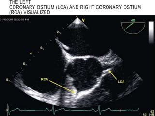THE LEFT
CORONARY OSTIUM (LCA) AND RIGHT CORONARY OSTIUM
(RCA) VISUALIZED
 