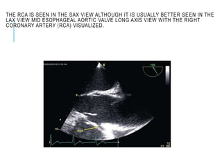 THE RCA IS SEEN IN THE SAX VIEW ALTHOUGH IT IS USUALLY BETTER SEEN IN THE
LAX VIEW MID ESOPHAGEAL AORTIC VALVE LONG AXIS VIEW WITH THE RIGHT
CORONARY ARTERY (RCA) VISUALIZED.
 