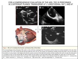 FOR A COMPREHENSIVE EVALUATION OF THE ASD, TEE IS PERFORMED
IN 3 DIFFERENT PLANES: TRANSVERSE (0°), LONGITUDINAL (90°), AND AT
45°.
 