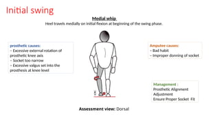 Initial swing
Medial whip
Heel travels medially on initial flexion at beginning of the swing phase.
prosthetic causes:
– Excessive external rotation of
prosthetic knee axis
– Socket too narrow
– Excessive valgus set into the
prosthesis at knee level
Amputee causes:
– Bad habit
– Improper donning of socket
Management :
Prosthetic Alignment
Adjustment
Ensure Proper Socket Fit
Assessment view: Dorsal
 