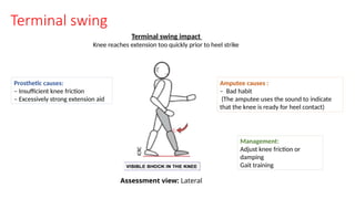 Terminal swing
Terminal swing impact
Knee reaches extension too quickly prior to heel strike
Prosthetic causes:
– Insufficient knee friction
– Excessively strong extension aid
Amputee causes :
– Bad habit
(The amputee uses the sound to indicate
that the knee is ready for heel contact)
Management:
Adjust knee friction or
damping
Gait training
Assessment view: Lateral
 