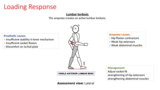 Loading Response
Lumbar lordosis
The amputee creates an active lumbar lordosis.
Prosthetic causes:
– Insufficient stability in knee mechanism
– Insufficient socket flexion
– Discomfort on ischial plate
Amputee causes:
– Hip flexion contracture
– Weak hip extensors
– Weak abdominal muscles
Management:
Adjust socket fit
strengthening of hip extensors
strengthening abdominal muscles
Assessment view: Lateral
 